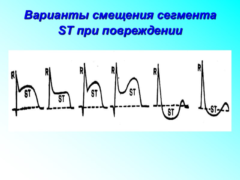 Варианты смещения сегмента ST при повреждении